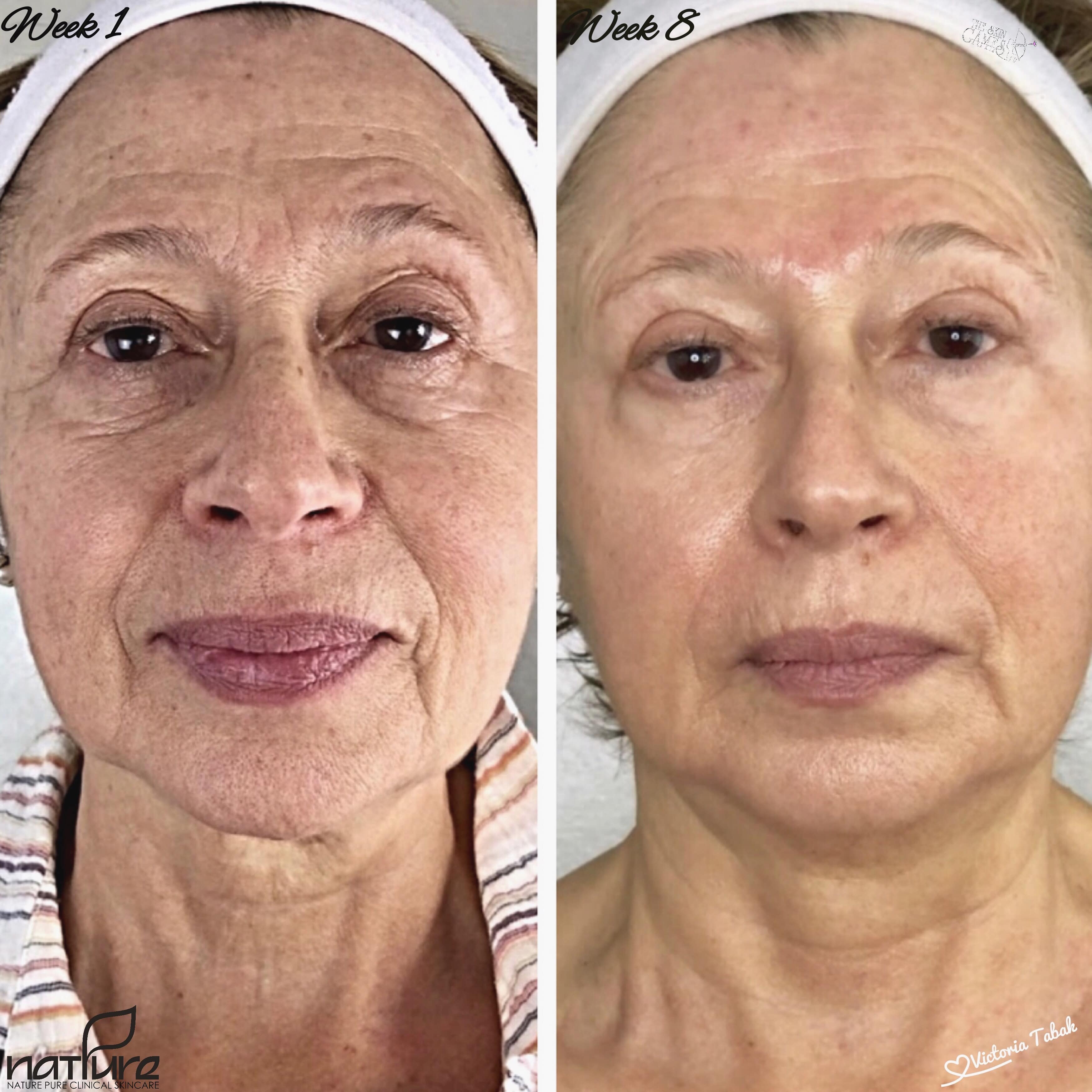 Dissolve Wrinkles & Reverse Menopausal Skin Changes Treatment Resource and Protocol